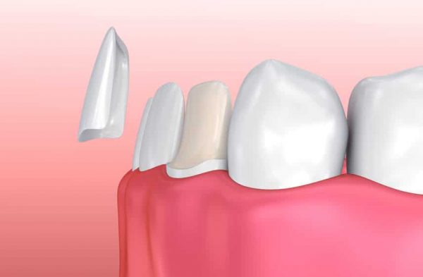veneers-74741602_s