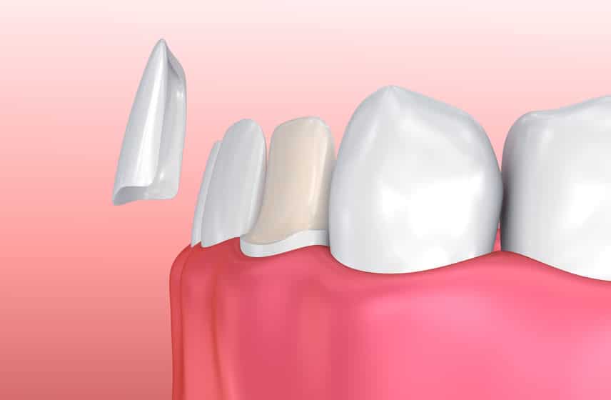 veneers-74741602_s