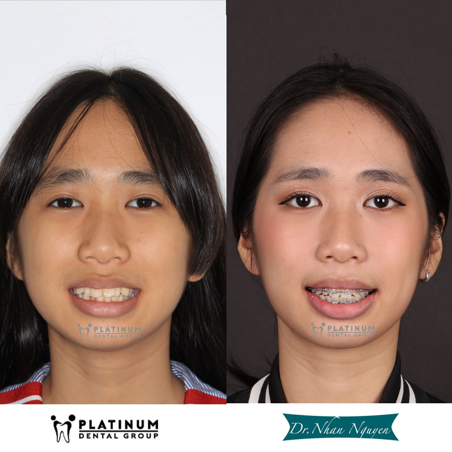 Hình ảnh Khách Hàng trước và sau khi niềng răng tại Platinum Dental
