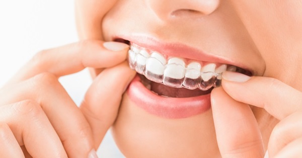 Niềng răng không mắc cài trong suốt mang đến nhiều lợi ích cho người điều trị