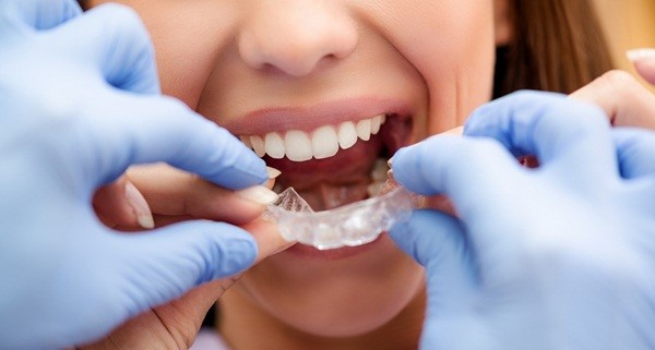 Phương pháp niềng răng không mắc cài Invisalign được nhiều người quan tâm và lựa chọn Chi phí niềng răng không mắc cài invisalign - Nha khoa Platinum