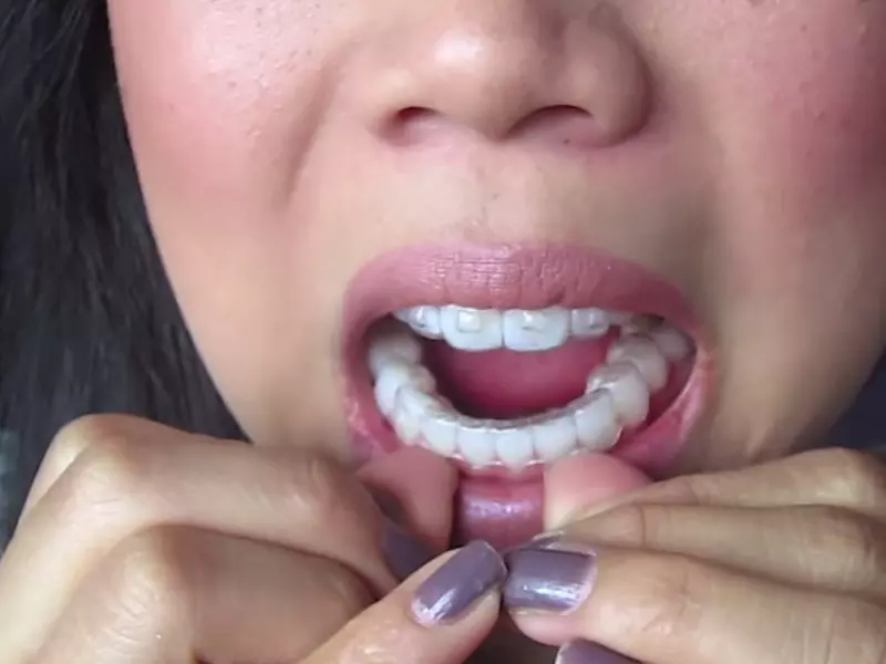 Ngoài ra, những vấn đề nhỏ khác có thể xảy ra như khó chịu hoặc đau nhẹ ở răng, nướu hoặc má.