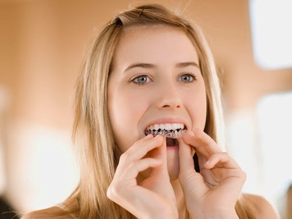 Phương pháp niềng răng này rất kín đáo và đảm bảo thẩm mỹ
