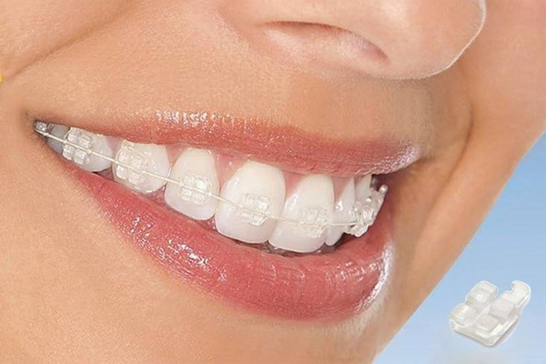 Các yếu tố ảnh hưởng đến chi phí niềng răng mắc cài sứ