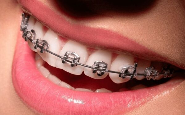 Bảo hiểm y tế không chi trả cho các dịch vụ niềng răng