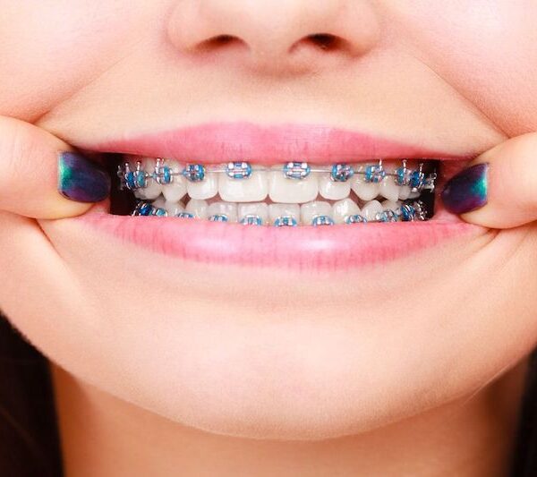 Lựa chọn địa điểm uy tín để niềng răng với chi phí hợp lý nhất