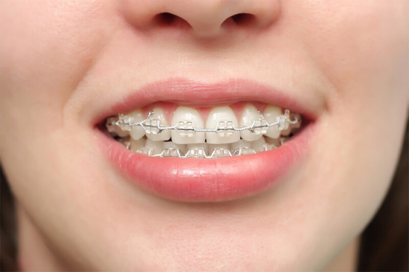 Niềng răng hô giá bao nhiêu ? Những chi phí có thể phát sinh khi niềng răng hô