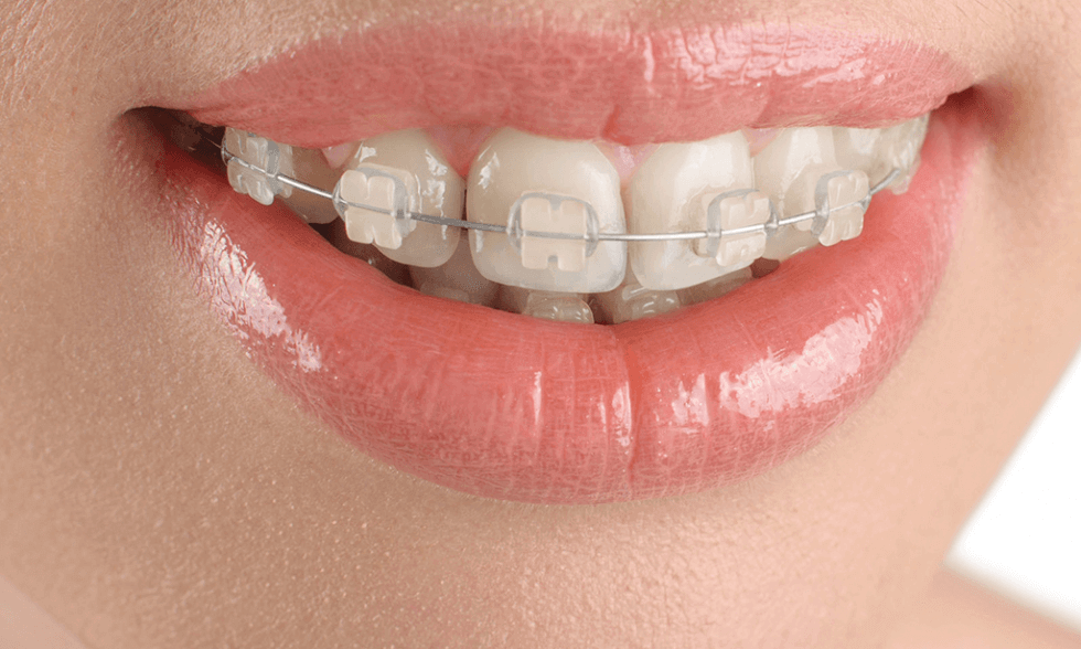 niềng răng mắc cài sứ
