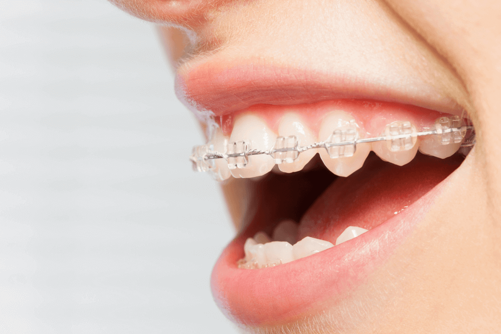 sử dụng phương pháp mắc cài tự buộc