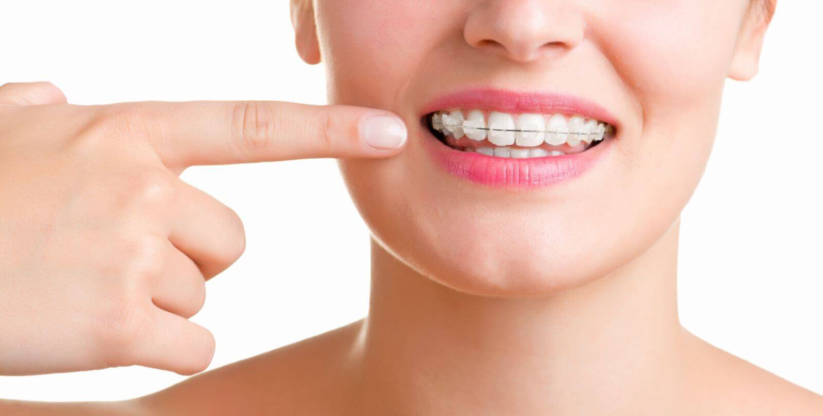 mắc cài sứ có dễ bị vỡ hay không