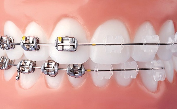 Niềng răng mắc cài sứ