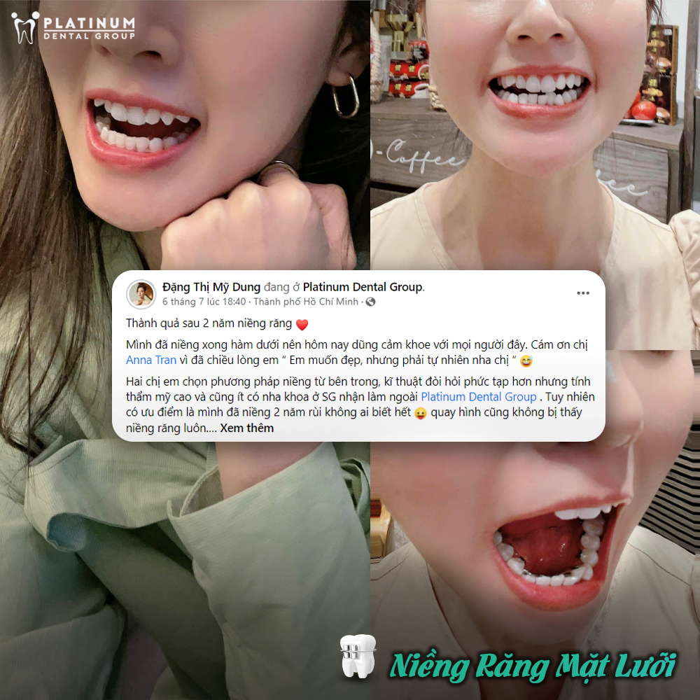 Diễn viên MiDu hoàn thành quá trình niềng răng tại Platinum Dental