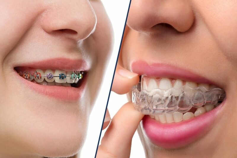 Tiêu chí lựa chọn điểm niềng răng uy tín