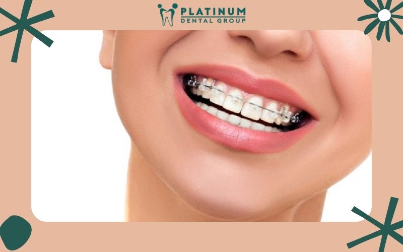 Top 10 địa chỉ niềng răng tốt và uy tín tại TPHCM