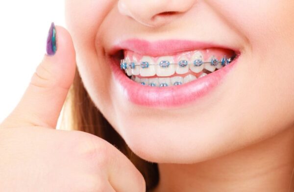 Lưu ý khi chọn địa điểm niềng răng