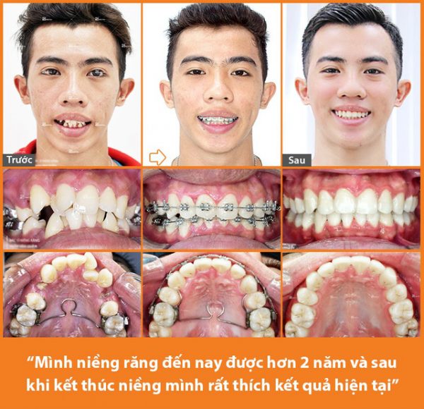 Niềng răng thẩm mỹ tại TPHCM ở nha khoa Platinum