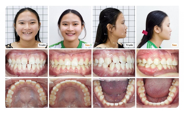 Niềng răng thẩm mỹ tại TPHCM ở cơ sở nha khoa Annna