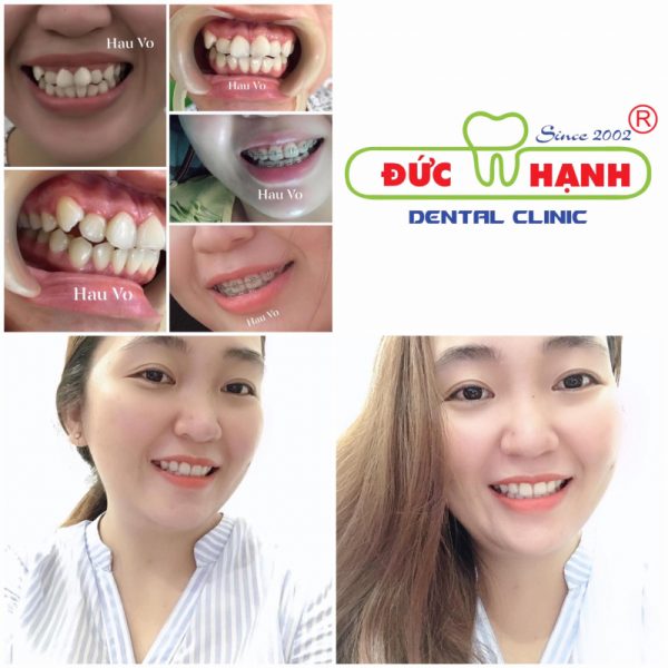 Niềng răng thẩm mỹ tại TPHCM ở nha khoa Đức Hạnh