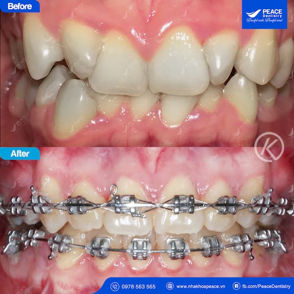 Niềng răng thẩm mỹ tại TPHCM ở Nha Khoa Peace Dentistry