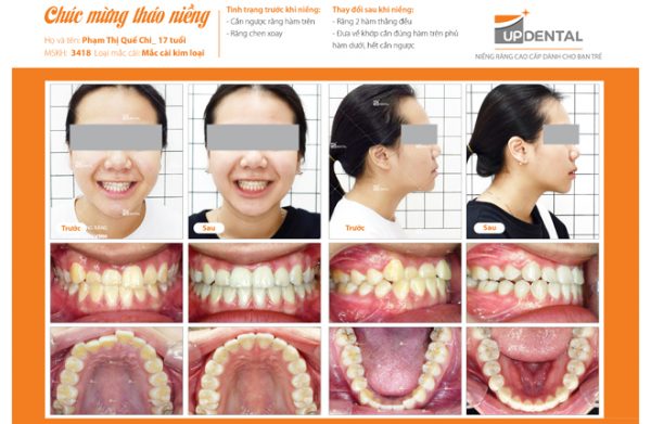 Niềng răng thẩm mỹ tại TPHCM ở Nha Khoa Up Dental