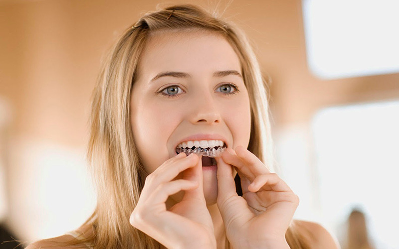 Cách thức hoạt động của niềng răng trong suốt khá đơn giản lại dễ chịu hơn niềng răng mắc cài nhiều