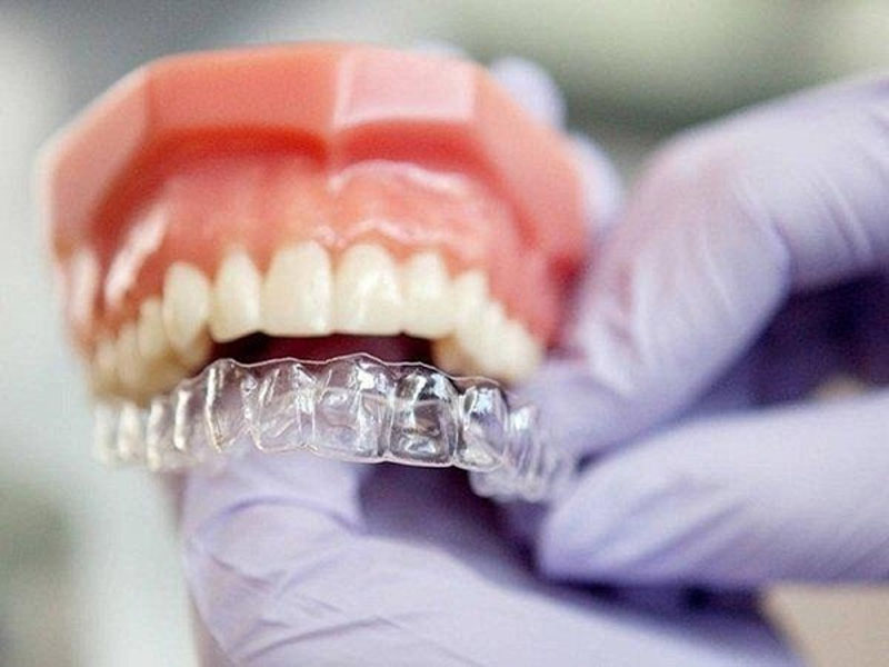 Niềng răng trong suốt - Các câu hỏi thường gặp là gì ?