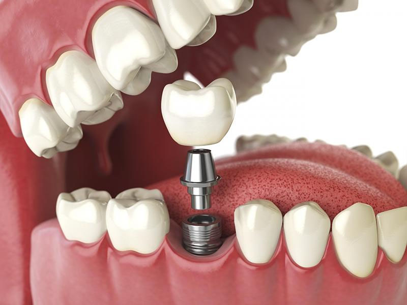 Trồng răng implant là gì?