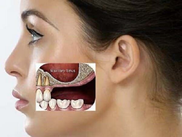 Tìm ra nguyên nhân để khắc phục niềng răng bị hóp má