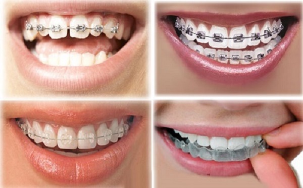 Lựa chọn phương pháp chỉnh nha phù hợp để khắc phục niềng răng bị hóp má