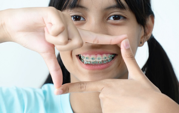Biện pháp khắc phục niềng răng bị hóp má là gì?