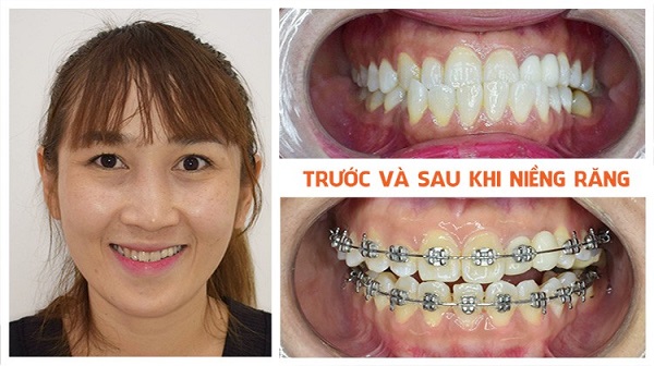 Vệ sinh răng miệng thật tốt để đảm bảo niềng răng móm tốt nhất