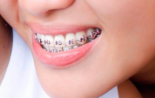 Có những phương pháp niềng răng bị móm như thế nào