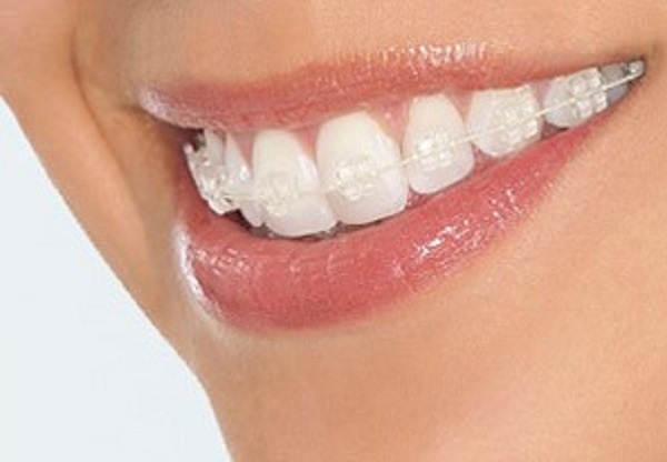 Niềng răng đúng cách sẽ tốt cho sức khỏe