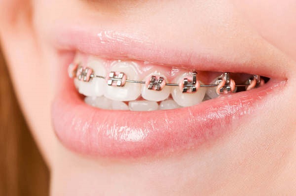 Niềng răng không đúng kỹ thuật có thể ảnh hưởng đến sức khỏe
