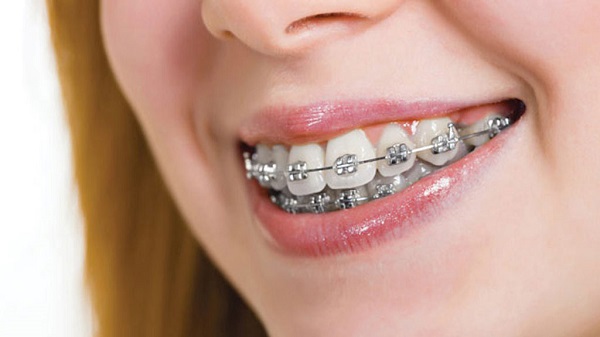 Nâng cấp răng miệng đều đặn đẹp mắt nhờ niềng răng