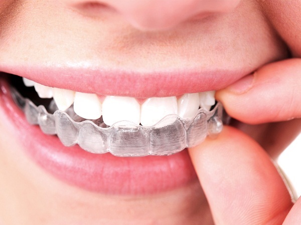 Các chọn lựa dành cho bạn khi tiến hành niềng răng