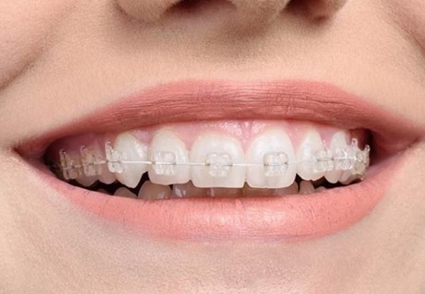 Vệ sinh răng miệng tốt để hàm răng sau niềng trở nên hoàn hảo