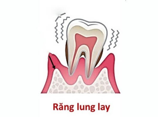 Những cách làm răng lung lay nhanh chóng tại nhà