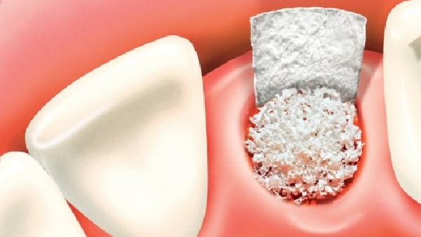 Nhổ răng tị nhà không đảm bảo vệ sinh dẫn đến nhiễm trung chân răng