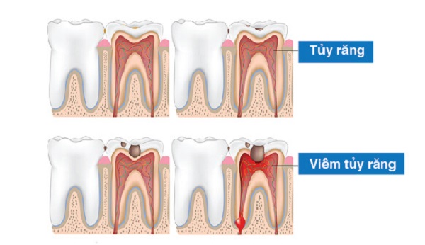 Hình ảnh tủy của răng bị viêm