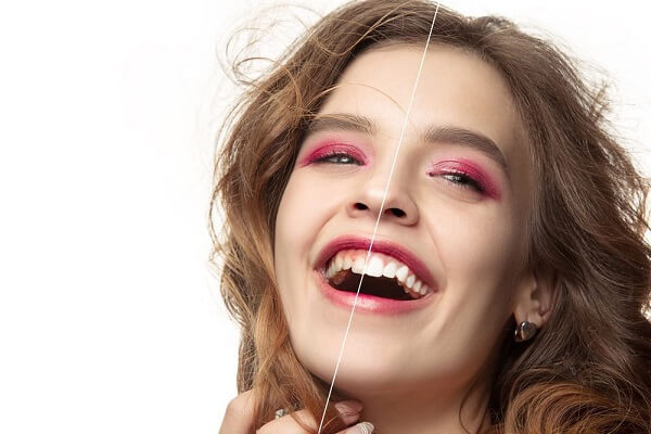 Kinh nghiệm làm răng Veneer là gì?