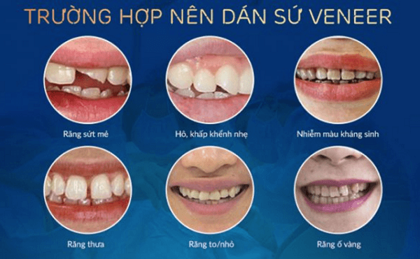 Kinh nghiệm làm răng Veneer cần xác định tình trạng răng