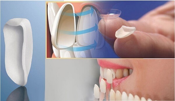 Kinh nghiệm làm răng Veneer cần xác định loại sứ phù hợp