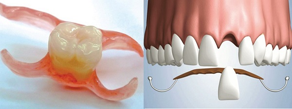 Phương pháp làm dài răng nanh tại các cơ sở nha khoa hiện nay.