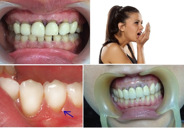 Biến chứng bọc răng sứ kém chất lượng