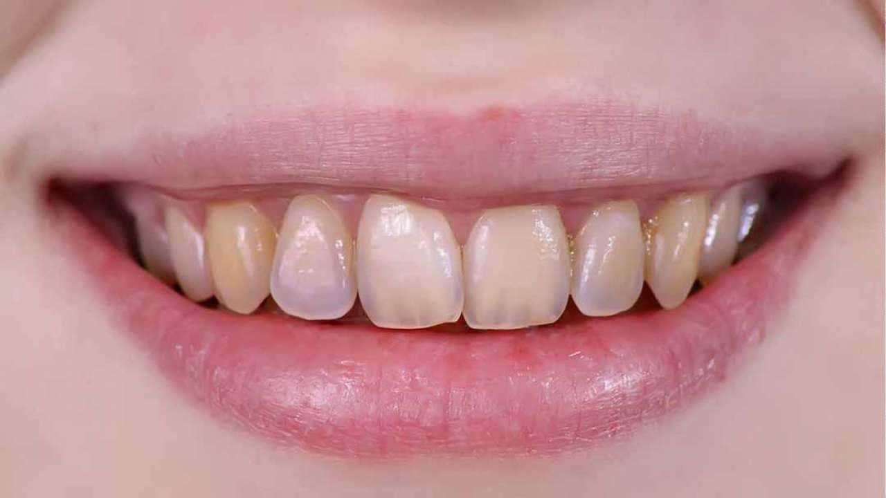 Bị vàng răng có thể là dấu hiệu của những bệnh gì?