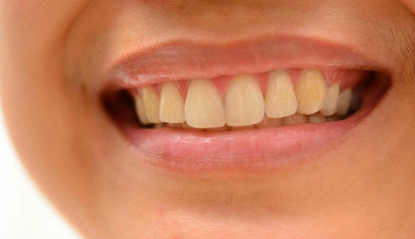 Nhiều người co răng vàng tự nhiên do di truyền