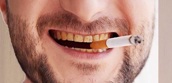 Thuốc lá gây răng ố vàng