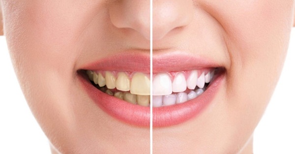 Cách để chữa răng ố vàng?