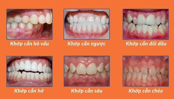 Hình ảnh minh họa của những hàm răng bị sai lệch